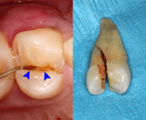 fracture tooth