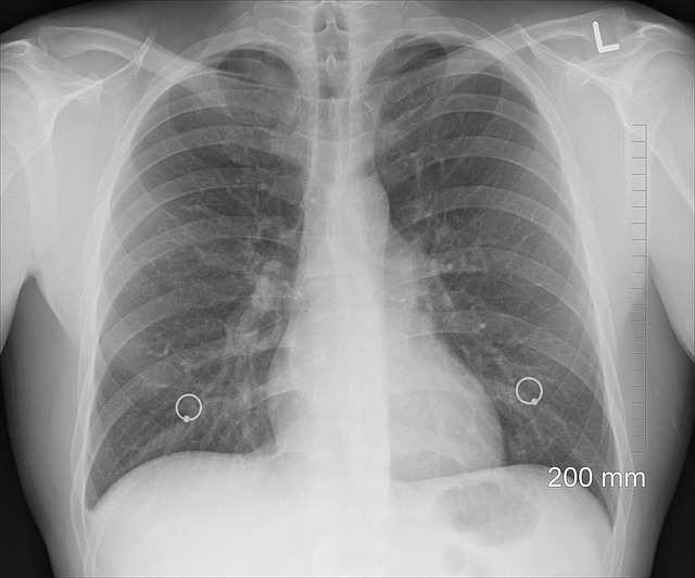 chest bone xray