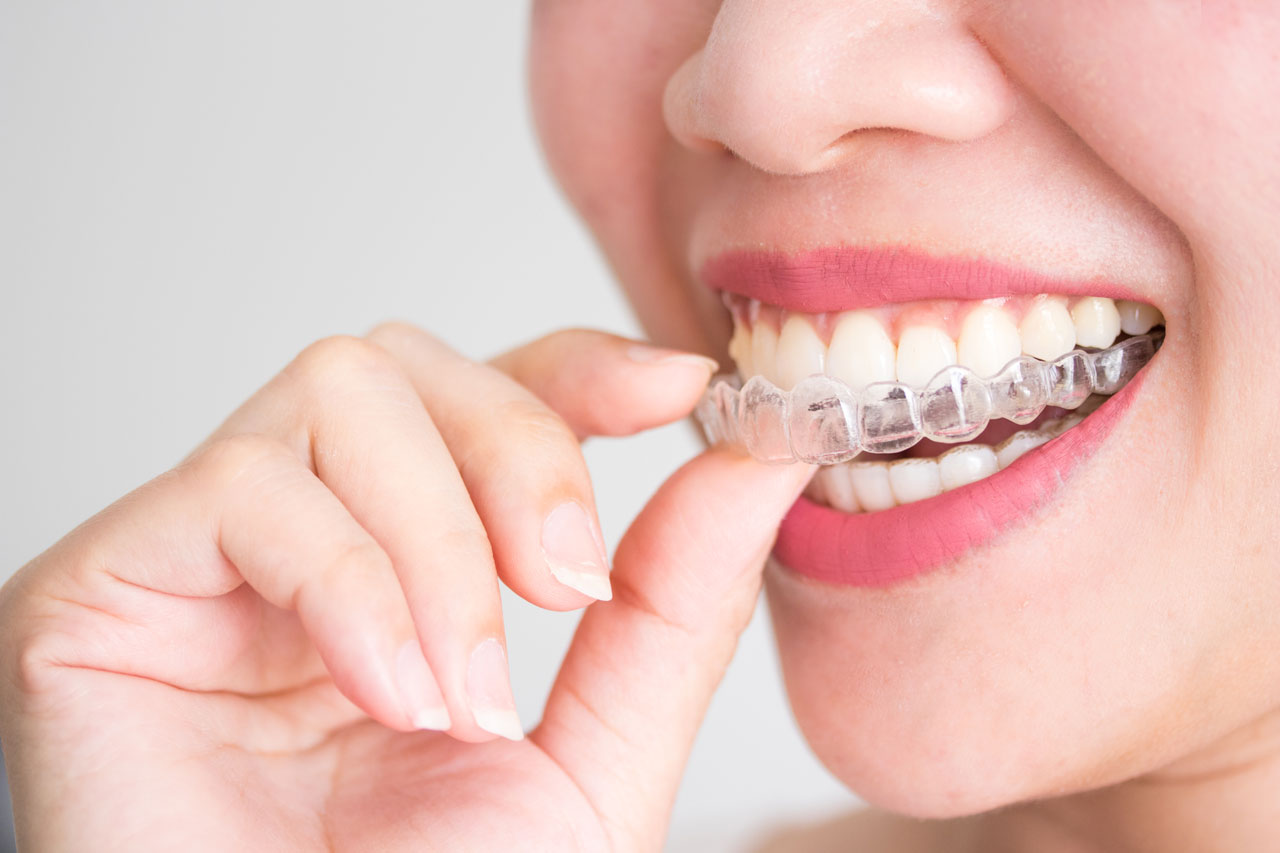Invisalign Retainers- What To Expect