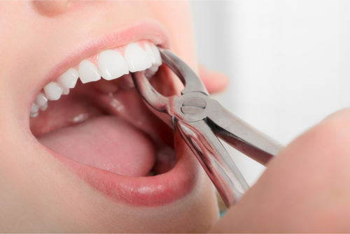 Looking For the Perfect Dentist for Tooth Extraction Near Me