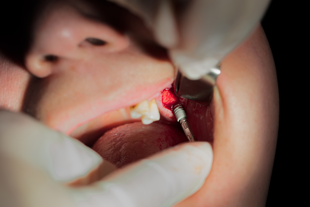 About Bone Grafts in Dental Implants