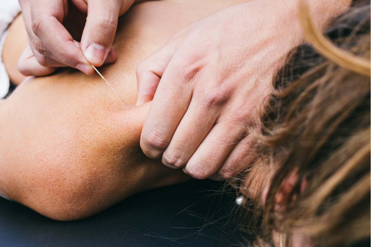 Muscle relief using dry needling: Is dry needling safe?