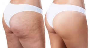 Cellulite Massage Before After