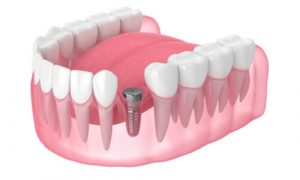 A sample of dental implant metal screw-like post.